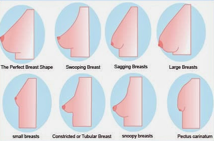 Tubular breast or tuberous breast is complex problem which has many  variations. The lower part of the breast does not fully form and appears  constricted by tight overlying skin. The fold under