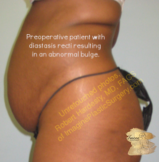 Abdominoplasty (“Tummy Tuck”) - Body Contouring - Imagine Plastic