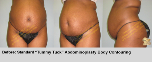 Abdominoplasty (“Tummy Tuck”) - Body Contouring - Imagine Plastic Surgery