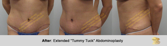 Ford Plastic Surgery - The gold standard for abdominal body contouring is  abdominoplasty or tummy tuck surgery with associated liposuction.  Abdominoplasty surgery tightens underlying rectus abdominis muscles to  improve waistline contour and
